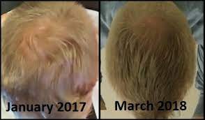How much does it cost to have a keeps subscription? Don T Buy Keeps Hair Loss Treatment Try This Instead Michael Saves
