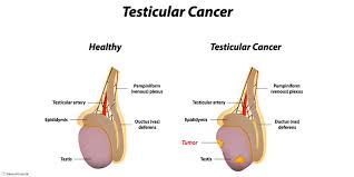 Testicular cancer symptoms can be similar to other conditions that affect the testicles, such as infections. Testicular Cancer Symptoms Private Gp Warwickshire Dr Jeff Foster