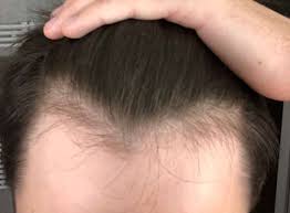 Haarausfall bei männern lässt sich in den weitaus meisten fällen als eine androgenetische alopezie (wörtlich: Hab Ich Schon Haarausfall Haare