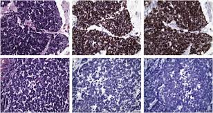 Image result for Merkel Cell Carcinoma