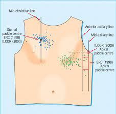 Larger paddles create a lower resistance and allow more current. Do Doctors Position Defibrillation Paddles Correctly Observational Study The Bmj