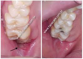 Dentes Do Siso Abc Da Saude