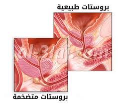 علاج التهاب وتضخم البروستاتا بالاعشاب