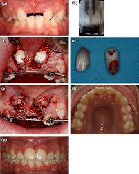 26,27 in the case shown here, closed eruption was chosen for the impacted central and. Clinical Recommendations For Management Of Mesiodens And Unerupted Permanent Maxillary Central Incisors Springerlink