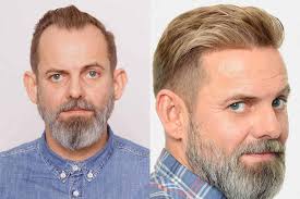 John frank, un medico che si occupa di trapianto di capelli, l'attore indossa una parrucca. La Stempiatura Fisiologica Puo Essere Considerata Calvizie Rephair