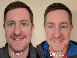 I Feel Like I M Doing Well After Finishing 3 Of 8 Months What Do You Think I M Already Less Shy About Smiling Smiledirectclub