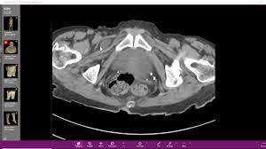 Hernia Obturatoria Youtube