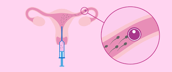 Die einnistung erfolgt fast immer 8 bis 10 tage nach dem eisprung. Intrauterine Insemination Was Ist Das