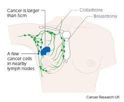 Metastatic breast cancer commonly spreads to the bones. Stage 3 Breast Cancer Cancer Research Uk