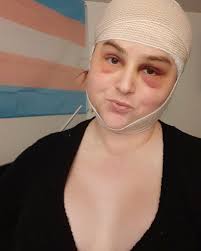 Hair loss due to medication side effects