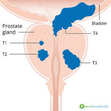 If your prostate cancer is thought to have recurred in only a small area and has not spread to other areas of the body, then radiation therapy to that area may be an option. Prostate Cancer Stages Explained Ben S Natural Health