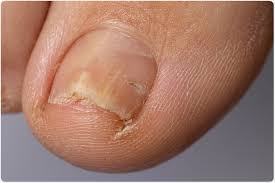Image result for onychomycosis