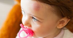 Kesimpulannya, perlukah mengkhawatirkan bekas luka pada anak? Cara Penyembuhan Bekas Luka Pada Bayi Popmama Com