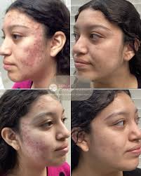 Hello! My name is Kaitlin Harrison and I'm the esthetician here at Palm  Desert Dermatology. I provide services such as chemical peels, Diamond Glow  facials, Microdermabrasion and Dermaplane. I am passionate about