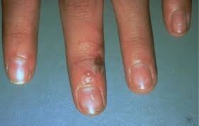 Herpes simplex virus (hsv) is a member of the alphaherpesvirinae subfamily of the herpesviridae family. Herpes Simplex Pariser Dermatology