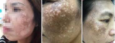 Mặt loang lổ như pháo hoa vì đắp "thần dược" trị nám