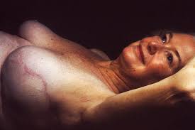 How much does breast reconstruction cost after mastectomy. Breast Reconstruction Wikipedia
