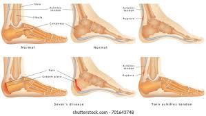 Image result for Calcaneal Apophysitis