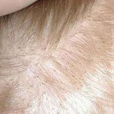 I've even had my entire history every once in a while my scalp kind of itches, and i always get this awful gross feeling that i have lice running around. Pin On Breakfast