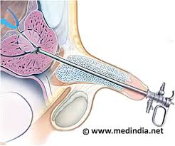 Nonsurgical Treatment for Prostate Enlargement Underway