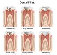7 natural remedies for cavities. Dental Filling Procedure