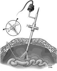 Pdf Laparoscopic Ventriculoperitoneal Shunt Placement A Single Trocar Technique Semantic Scholar