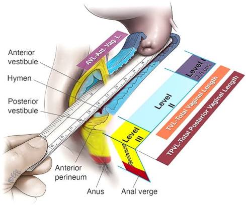 Surgical anatomy of the mid‐vagina - Haylen - 2022 - Neurourology and  Urodynamics - Wiley Online Library