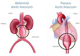 Aortic Aneurysm Surgery In Spring Hill Florida 352 505 1737 Aortic Aneurysm Aneurysm Abdominal Aortic Aneurysm