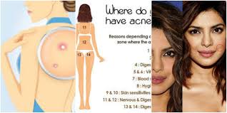 This Body Chart Explains Why Your Acne Keeps Coming Back