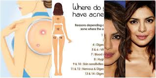 this body chart explains why your acne keeps coming back