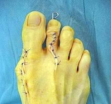 Der gelenkspalt muss im röntgenbild noch deutlich sichtbar sein. Hallux Valgus Wikipedia