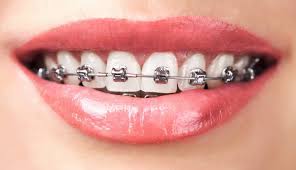 These aligner trays are made of smooth, comfortable and virtually invisible plastic that you wear over your teeth. Braces For Teeth Auckland Braces Experts Shakespeare Orthodontics