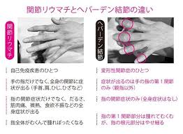 女性が9割 ヘバーデン結節とは 関節リウマチとの違いはココ 特選街web 結節 関節リウマチ 専門医