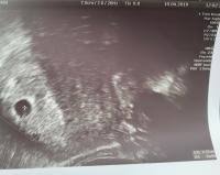 Zwar kann der herzschlag des embryos bereits gegen ende der 6. Ssw 6 0 Kein Herzschlag Forum Schwangerschaft Urbia De