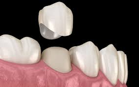 Bei stark zerstörten kronen kann ein stift notwendig sein. Kronen Und Teilkronen Zahnarztpraxis Dr Gottwald In Koblenz