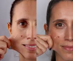 Tudo sobre bioestimuladores