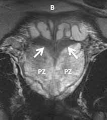 Normal Central Zone Of The Prostate And Central Zone Involvement By Prostate Cancer Clinical And Mr Imaging Implications Radiology