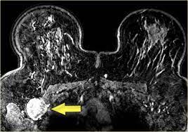 Breast magnetic resonance imaging (mri). The Radiology Assistant Mri Of The Breast