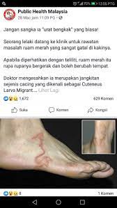Pertama suhu demam bayi yang tidak terlalu panas dan boleh dikawal dengan makan ubat demam. Sakit Urat Selepas Ke Pantai Siap Mengurut Rupa Rupanya Cacing Berzumba Dalam Kaki Jangan Ulangi Apa Yang Wanita Ini Buat Viral Mstar