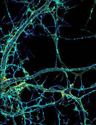 Esclerosis lateral amiotrófica, sus causas, síntomas, y toda la mayor información sobre el ela. Un Nuevo Gen Permite Relacionar Los Defectos Citoesqueleticos Con La Esclerosis Lateral Amiotrofica Genotipia
