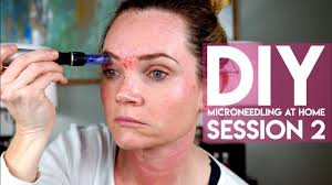 Check spelling or type a new query. Microneedling At Home Derma Pen Session 2 Youtube