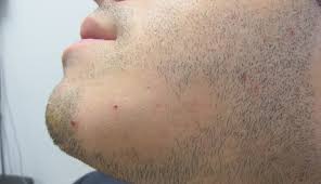 But as far as i when i trim it very short the colors stay. Patchy Hair Loss On A Bearded Chin Clinical Advisor