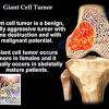 Enneking classification of malignant bone tumors. 1