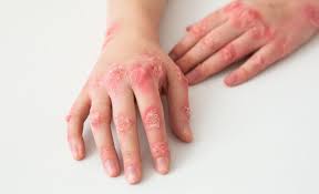 Image result for Primary Syphilis