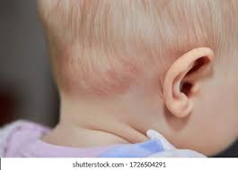 Image result for sweat rash on back baby