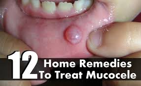 Mucous retention cysts are formed as a result of obstruction of a submucous mucinous gland and serous cysts occur as a result of accumulation of fluid in the submucosal layer of the it is a true cyst with an epithelial lining. 12 Effective Home Remedies To Treat Mucocele Find Home Remedy Supplements