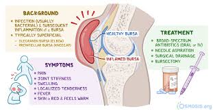 Image result for Bursitis