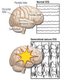 Seizures, also known as fits or convulsions or epilepsy, are characterized by jerky movements of the body, during which the child loses consciousness and is unaware of his/her surroundings. Absence Seizures Petit Mal Seizures Harvard Health