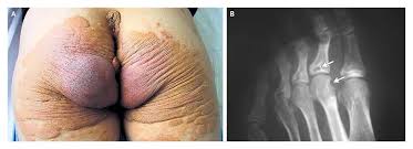 Image result for Hypercholesterolemia