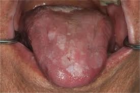 Image result for lichen planus on tongue)